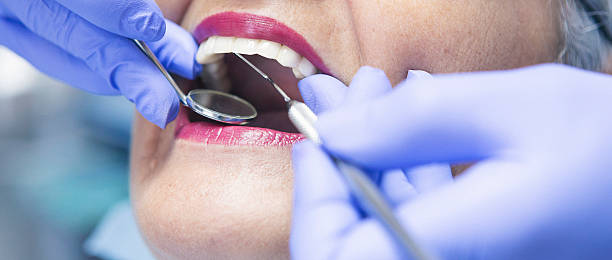 Best Emergency Dentist for Lost Fillings or Crowns in Five Points, FL